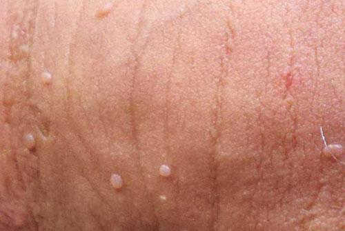 Cách chữa sùi mào gà giai đoạn đầu và phòng bệnh hiệu quả