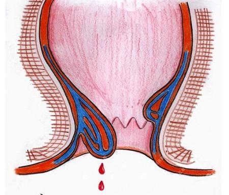 3 cách điều trị bệnh trĩ chảy máu nổi tiếng hiệu quả