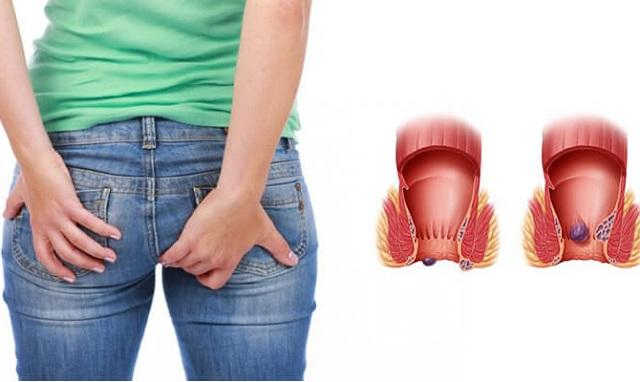Tổng hợp 4 phương pháp chữa bệnh trĩ hiệu quả