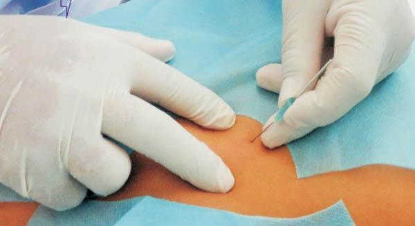 Phương pháp cấy chỉ dương vật và những tác dụng không ngờ