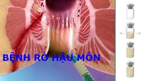 Rò rỉ hậu môn: Tác hại và giải pháp “vàng” trong điều trị