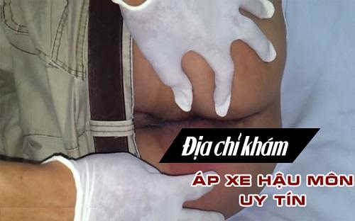 Khám áp xe hậu môn ở đâu tốt? [5 địa chỉ uy tín Hà Nội)