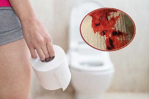 Đi ngoài ra cục máu đông coi chừng bệnh nguy hiểm!