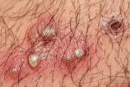 Mọc mụn ở vùng kín nữ - Cẩn thận bệnh sùi mào gà