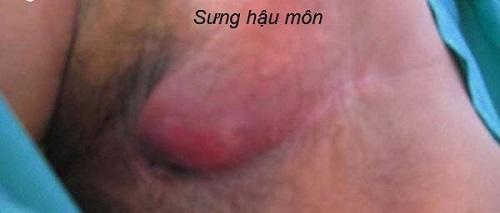 Hậu môn bị sưng – Triệu chứng nhiều bệnh lý nguy hiểm