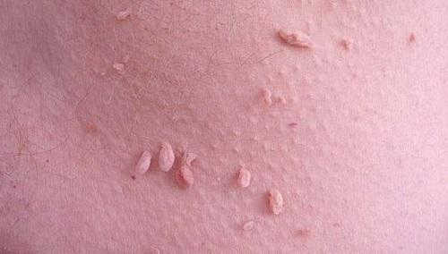 Vùng kín nổi mụn là gì? Nguyên nhân và cách điều trị