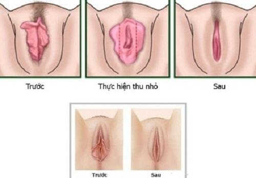 Thu hẹp vùng kín là gì? Lợi ích, quy trình, chi phí