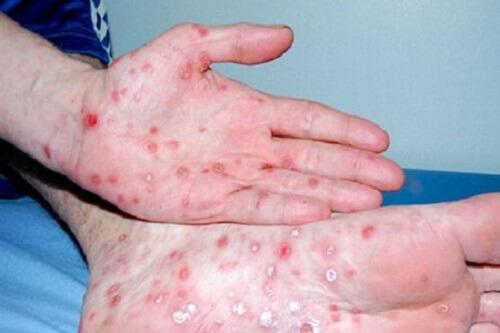 Bệnh giang mai ở nam giới: Nguyên nhân, triệu chứng và cách xử lý