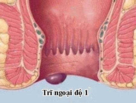 Bệnh trĩ ngoại cấp độ 1 là gì? Có tự khỏi không?