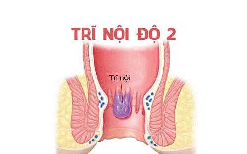 Trĩ nội độ 2 có chữa được không? Cách chữa tốt nhất