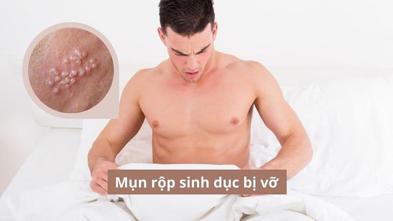 Những điều cần biết khi thấy mụn rộp sinh dục bị vỡ
