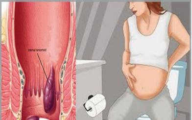 Bệnh trĩ ở người mang thai có nguy hiểm không? Cách điều trị hiệu quả nhất