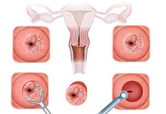 Chữa viêm cổ tử cung bằng phương pháp hiện đại