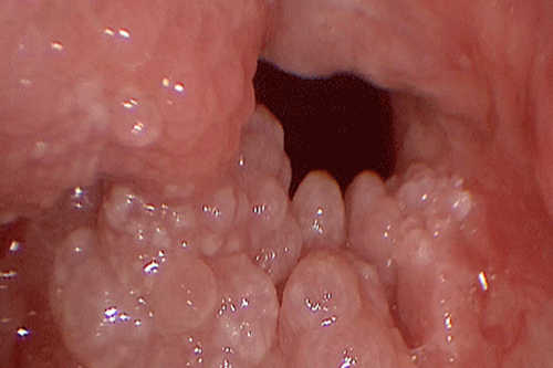 Đầu lưỡi nổi hột đỏ đau rát do u nhú tiền đình Papillonmatosis