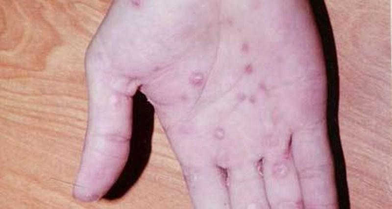 Giang mai- Nguyên nhân dẫn đến bệnh viêm tinh hoàn