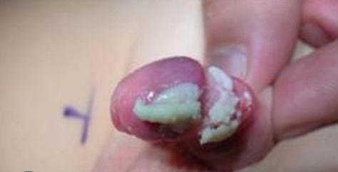 Bựa sinh dục: Nguyên nhân, dấu hiệu nhận biết và cách chữa trị