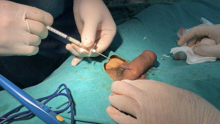 CÓ NÊN THỰC HIỆN PHẪU THUẬT TĂNG KÍCH THƯỚC DƯƠNG VẬT