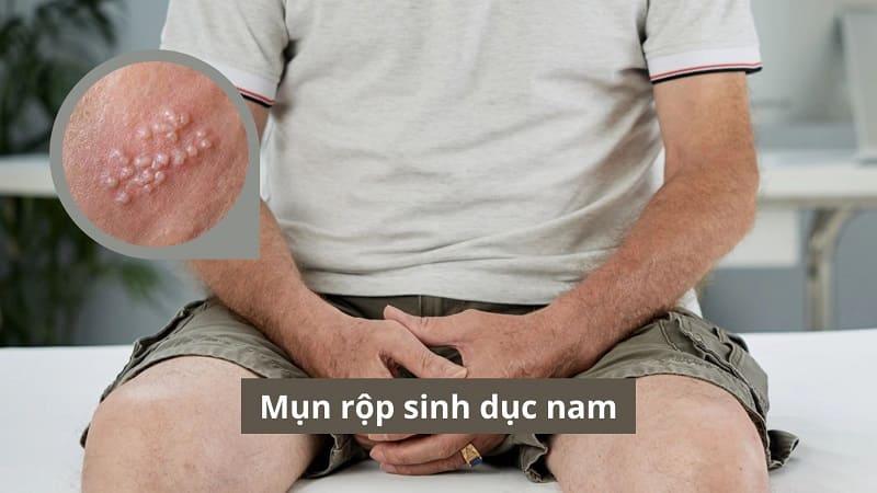 Mụn rộp sinh dục nam biểu hiện như thế nào, có nguy hiểm không?