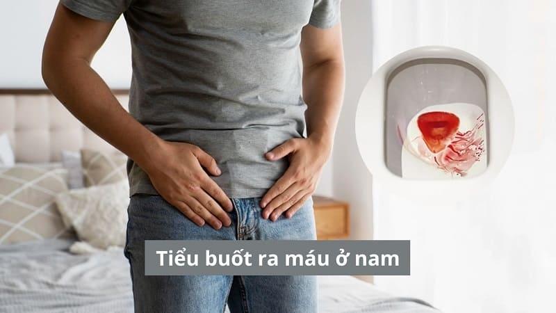 Tất cả thông tin cần biết về tiểu buốt ra máu ở nam