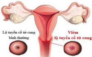 Dấu hiệu viêm lộ tuyến cổ tử cung cần biết