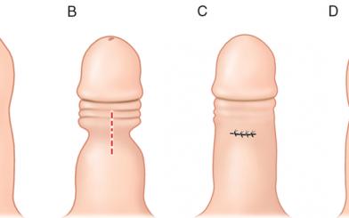 [Giải đáp] Sau khi phẫu thuật cắt bao quy đầu cần phải làm gì?