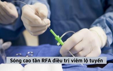 Sóng cao tần RFA điều trị viêm lộ tuyến và những thông tin quan trong chị em nên biết