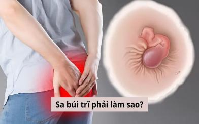 Sa búi trĩ phải làm sao? Cách điều trị hiệu quả hiện nay