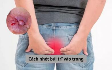 Hướng dẫn cách nhét búi trĩ vào trong đơn giản và an toàn