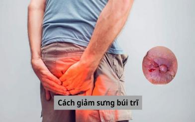 Tham khảo các cách giảm sưng búi trĩ dễ thực hiện tại nhà 