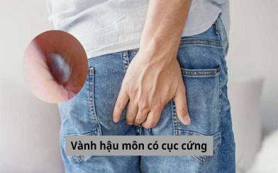 Vành hậu môn có cục cứng cảnh báo bệnh gì? Khi nào cần đi khám? 