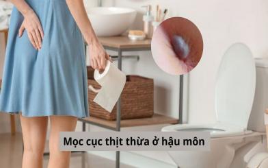 Mọc cục thịt thừa ở hậu môn: Nguyên nhân và cách điều trị hiệu quả