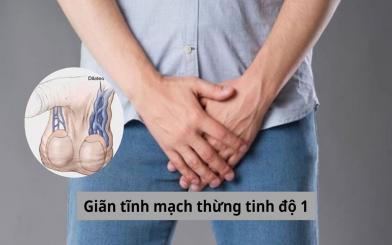 Giãn tĩnh mạch thừng tinh độ 1: Nhận biết dấu hiệu và cách điều trị