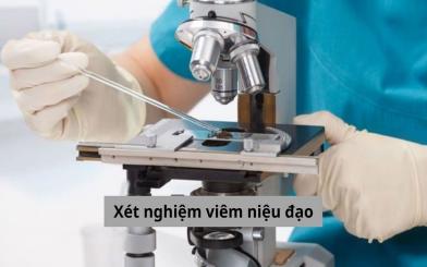 Xét nghiệm viêm niệu đạo và những điều bạn cần phải biết