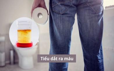 Tiểu dắt ra máu - Đơn thuần là sự thay đổi sinh lý hay cảnh báo dấu hiệu bệnh lý?