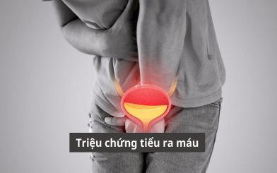 [CẢNH BÁO] Thận trọng với 5+ bệnh lý có triệu chứng tiểu ra máu 