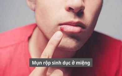 Nguyên nhân và phương pháp điều trị mụn rộp sinh dục ở miệng