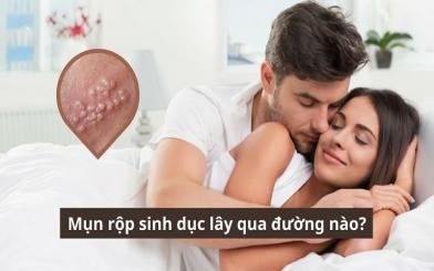 Mụn rộp sinh dục lây qua đường nào? 5 con đường lây bệnh không nên chủ quan