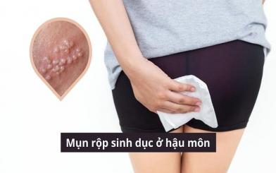 Mụn rộp sinh dục ở hậu môn: Dấu hiệu nhận biết, nguyên nhân và cách xử lý an toàn