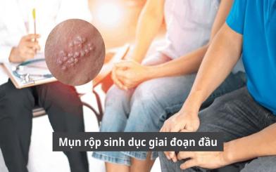Cảnh giác dấu hiệu mụn rộp sinh dục giai đoạn đầu ở cả nam và nữ