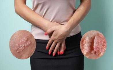 Mụn rộp sinh dục và sùi mào gà: Cẩn thận nhầm lẫn giữa 2 bệnh xã hội nguy hiểm