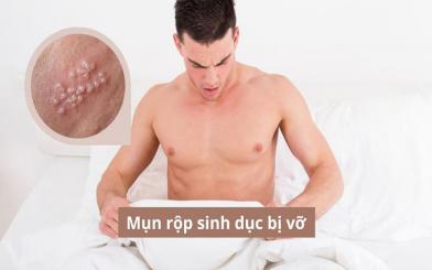 Những điều cần biết khi thấy mụn rộp sinh dục bị vỡ
