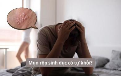 Mụn rộp sinh dục có tự khỏi và cách chữa mụn rộp sinh dục hiệu quả
