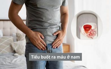 Tất cả thông tin cần biết về tiểu buốt ra máu ở nam