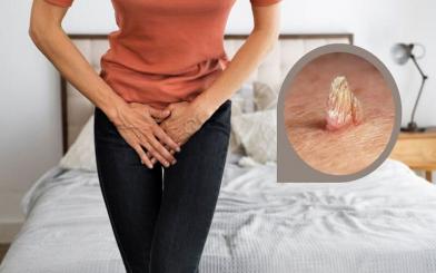 Đặc điểm bệnh sùi mào gà ở bộ phận sinh dục nữ và cách chữa hiệu quả
