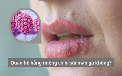 [Giải đáp] Quan hệ bằng miệng có bị sùi mào gà không? Nguy hiểm thế nào?