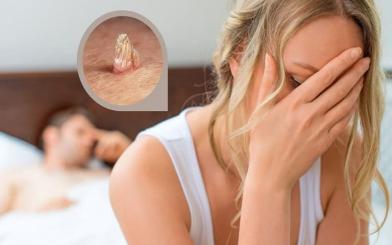 Gỡ rối băn khoăn: Vợ bị sùi mào gà chồng có bị không?
