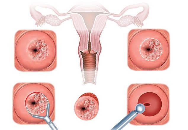 Viêm cổ tử cung: triệu chứng, nguyên nhân và những tác hại nguy hiểm 