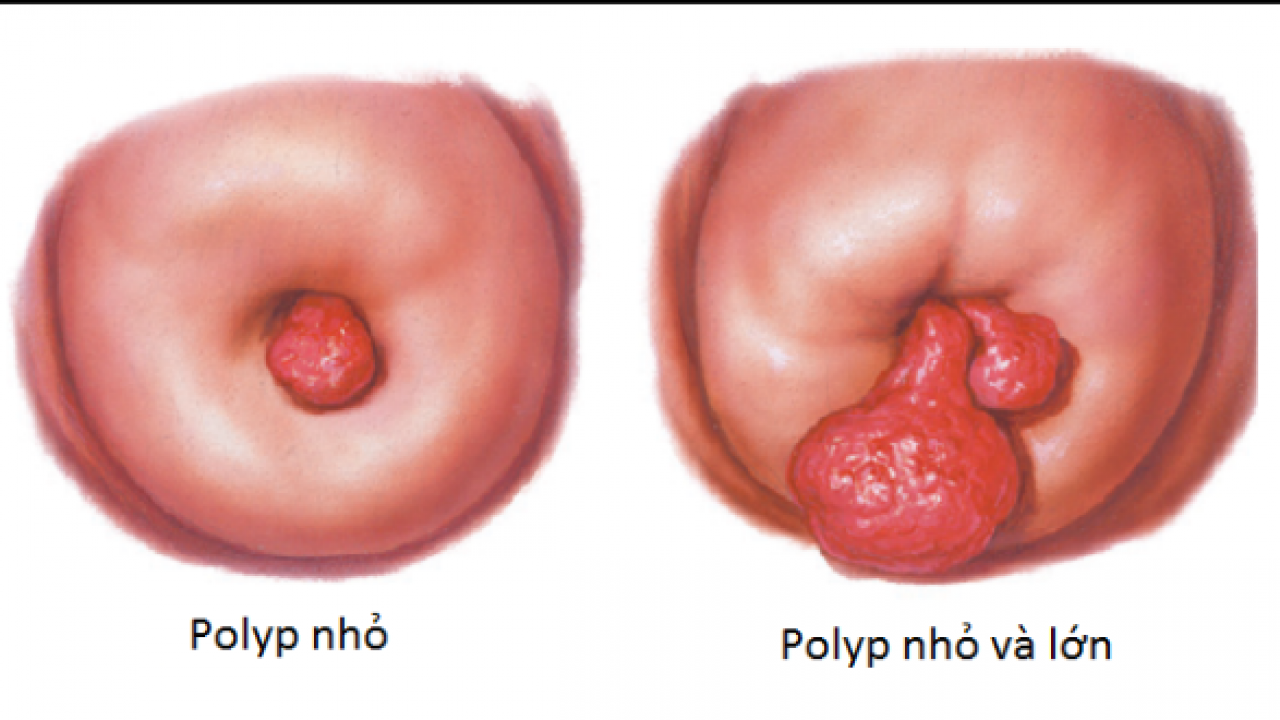 Do mắc bệnh Polyp tử cung hoặc âm đạo
