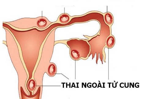 Thai ngoài tử cung 