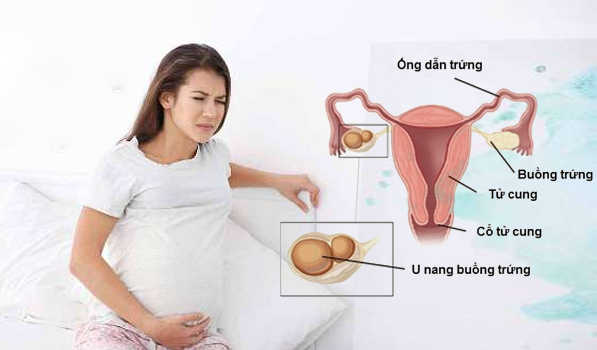 U nang buồng trứng khi mang thai là gì? Có gây nguy hiểm không?